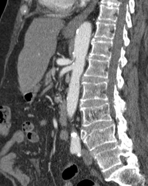 Ligament Syndrome Imaging Sexiezpicz Web Porn
