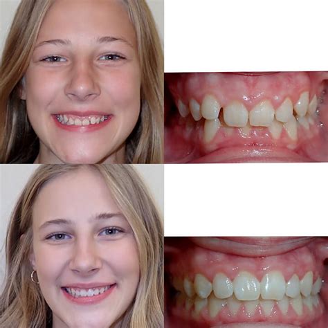 Before And After Invisalign Wazio Orthodontics