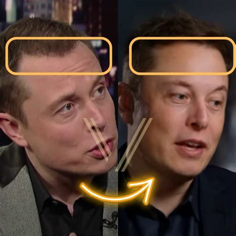 Elon Musks Hair Transplant Before And After Transformation