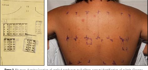 Figure 2 From Basics Of Patch Testing For Allergic Contact Dermatitis