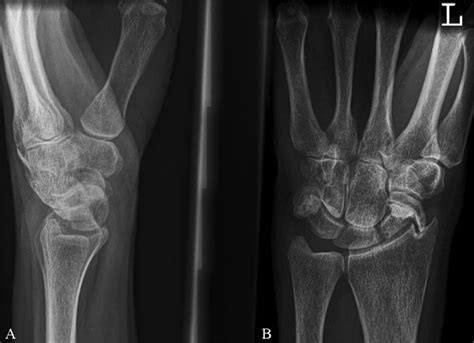 The Natural History Of A Missed Scaphoid Fracture Musters Journal