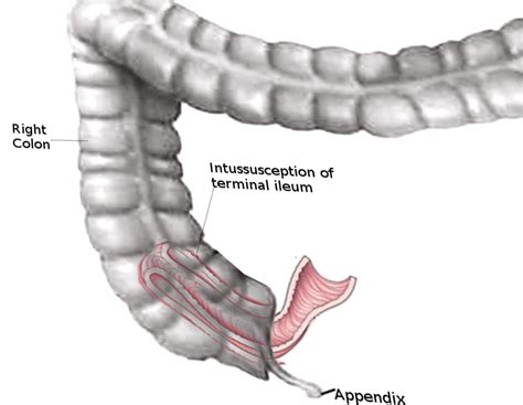 Intussusception In Adults Treatment And Management Point Of Care