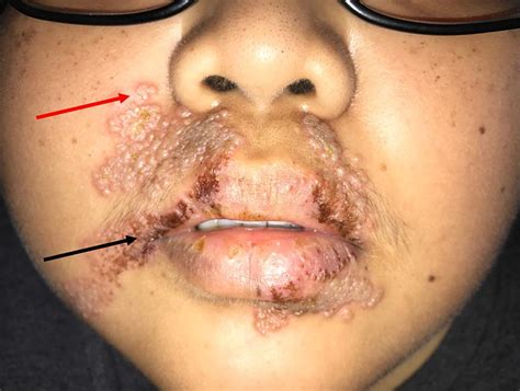 This section explains the methodology used for the skin detection in. An extensive perioral rash | The BMJ