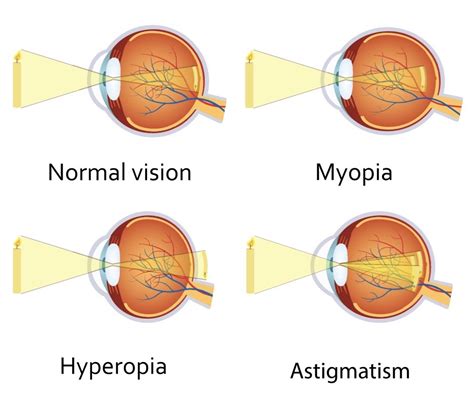 Gejala myopia atau lebih dikenali sebagai penglihatan pendek. Masalah Rabun? Kini Eye Care Membantu Anda Mengatasinya