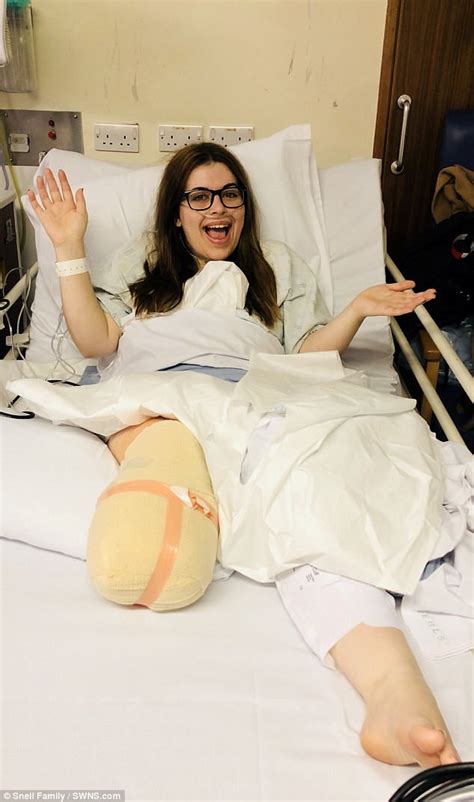 Woman 26 Decided To Have Her Right Leg Amputated After Her Fracture Wouldnt Heal Daily Mail