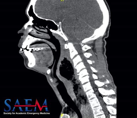 Saem Clinical Image Series Worsening Sore Throat