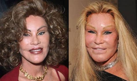 Most Shocking Celebrity Before And After Plastic Surgery Shots Bad Celebrity Plastic