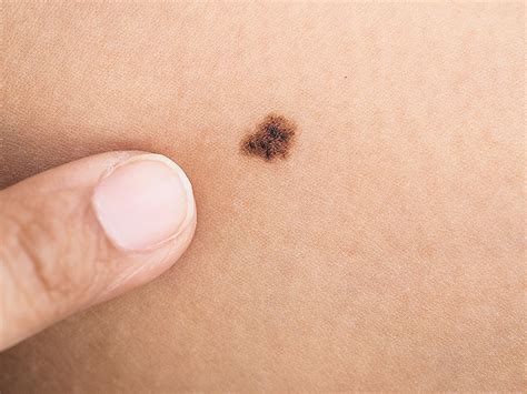 Simple Melanoma Risk Test Count The Moles On An Arm My XXX Hot Girl