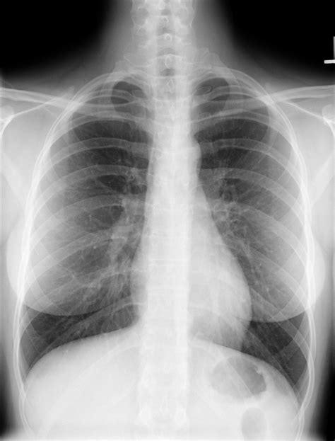 X Ray Of Normal Chest Female Eccles Health Sciences