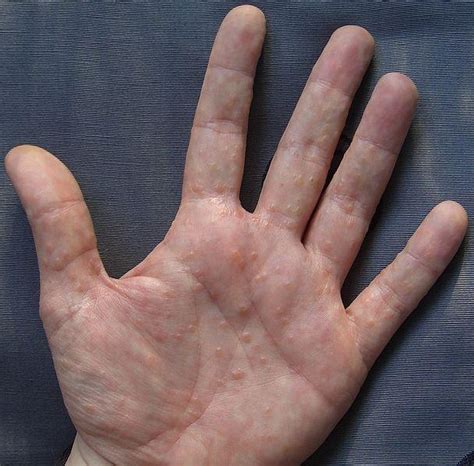 Palm Skin Rash Types Causes Pictures Treatment