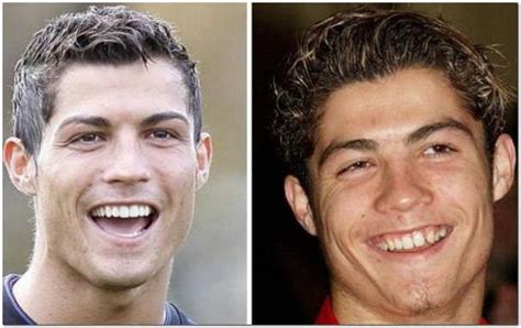 Cristiano Ronaldo Plastic Surgery Before After Cristiano Plastic Ronaldo Surgery