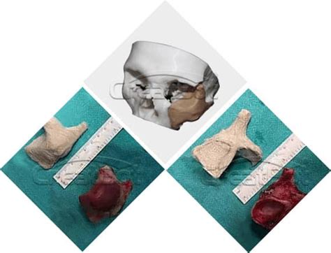 Peek Implant Htr Prosthesis For Cranioplasty Using Creatbot Technology