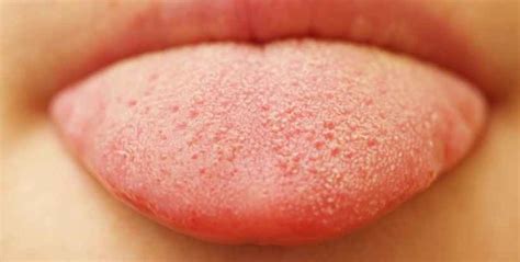 Bumps On The Tongue 9 Common Causes Pictures Treatment