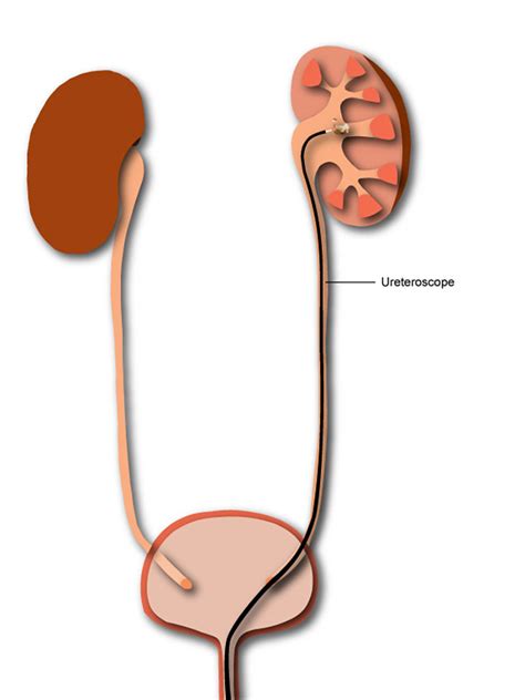 What Is A Ureteroscopy Urology Specialist Sydney