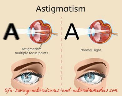 Nasal vestibulitis, or nasal folliculitis, is a rare type of bacterial infection at the opening of the nose. A Home Remedy for Astigmatism That Works Like a Charm ...