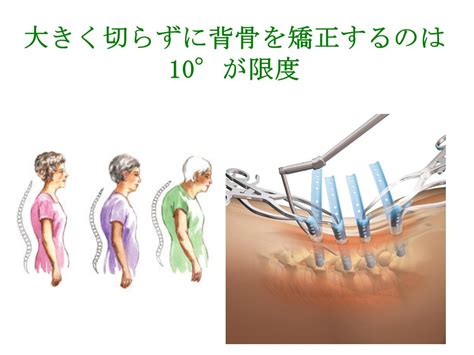 大きく切らずに背骨を矯正するのは10°が限度 - 戸田整形外科 ...
