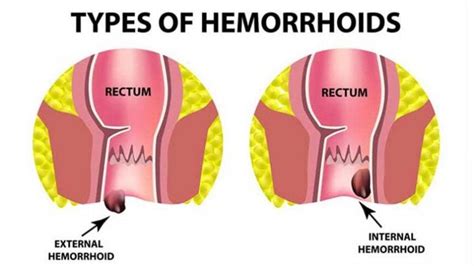 home treatments for hemorrhoids entirely health