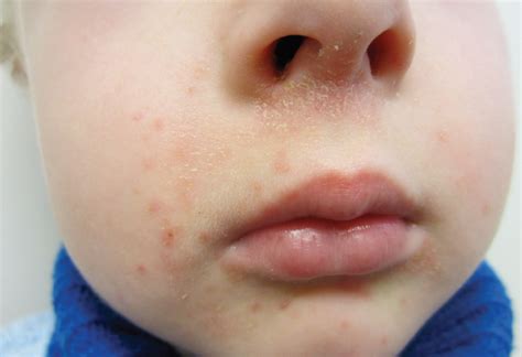 Multiple Erythematous Papules On A 6 Year Olds Face Consultant360