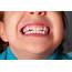 Children Embarrassed To Smile Because Of Their Teeth  Dentistrycouk