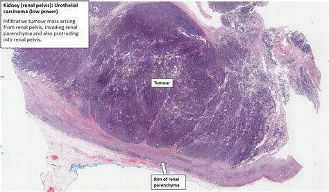 Kidney Renal Pelvis Urothelial Carcinoma Nus Pathweb Nus Pathweb