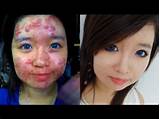 Pictures of Makeup To Cover Acne