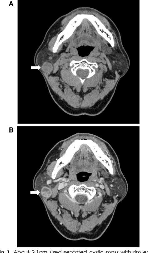 Figure 1 From A Case Of Parotid Tuberculosis Mimicking Benign Tumor Of
