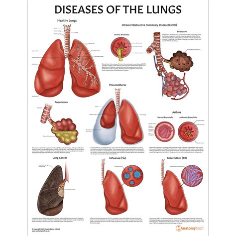 Diseases Of The Lung Anatomy Poster Clinicalposters P