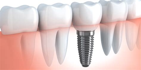 Single Dental Implants Madison And Pearl Ms Key Dental Group