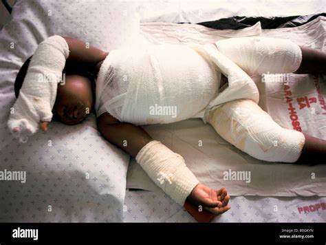 A Child Wrapped In Bandages At A Burns Unit In Baragwanath Hospital