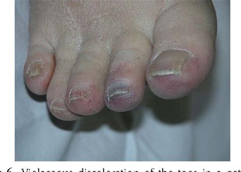 Figure 2 From Blue Toe Syndrome From Decreased Arterial Perfusion