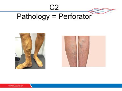 Venous Perforator Treatment Vascular Surgeon Dubai Dr Amit Kumar