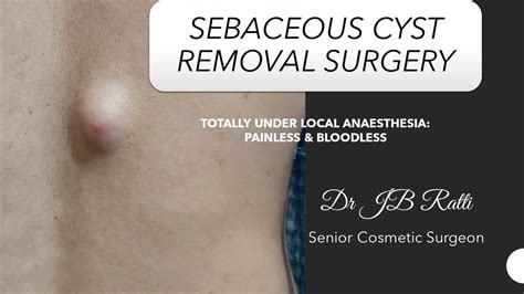 Sebaceous Cyst Surgery Sebaceous Cyst Surgery In Delhi Best