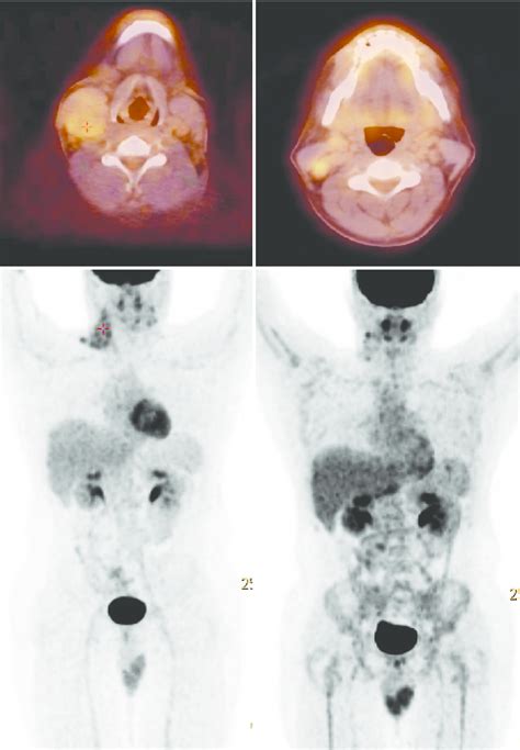 Case Of Hodgkins Lymphoma A Baseline Mip Image And Axial Neck