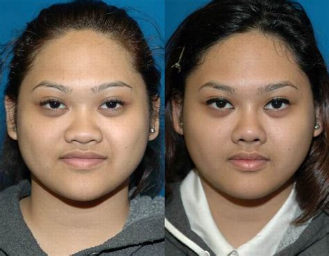 Nose Job Before And After Asian Women