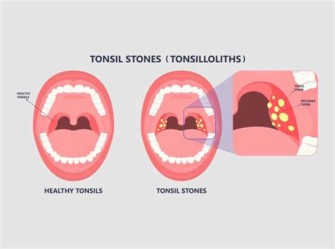 Bad Breath Sore Throat And Tonsil Stones Bergerhenry Ent Specialty