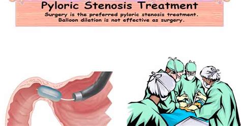 Pyloric Stenosis Treatment Pyloric Stenosis Surgery
