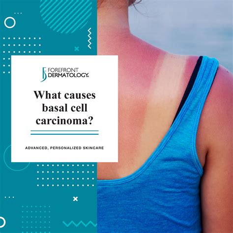 Definition of basal cells with photos and pictures, translations, sample usage, and additional links for more information. What Causes Basal Cell Carcinoma? | Forefront Dermatology ...