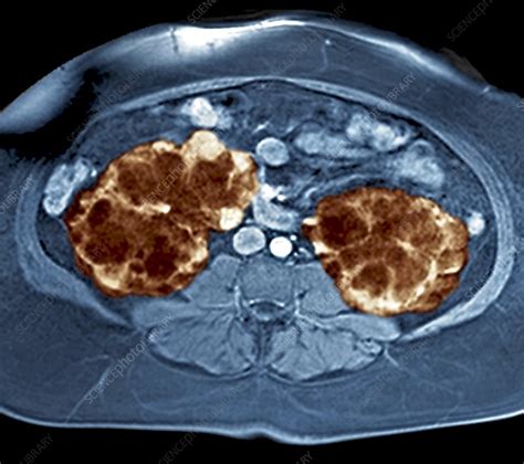 Polycystic Kidneys Mri Scan Stock Image M1950196 Science Photo