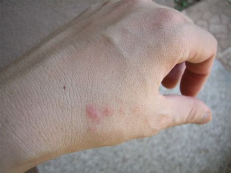 Bed Bug Bite Treatment Tips Bed Bug Treatment Site