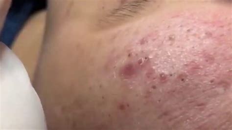 Acne Removal Acne Treatment Severe Infected Acne Blackheads Removal