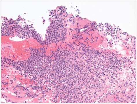 Facial Neutrophilic Dermatosis Mimicking Iododerma And Associated With