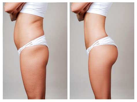 Brazilian Butt Lift With Fat Transfer New Skin Laser Center