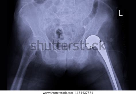 Xray Image Show Total Hip Arthroplasty Stock Photo 1151437571