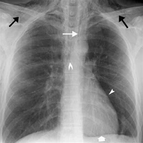 Anteroposterior Chest X Ray Note Subcutaneous Emphysema In The Neck