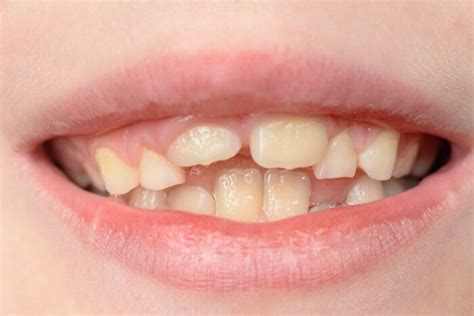 Crooked Teeth In Children Here Is What You Can Do Project Wellness Now