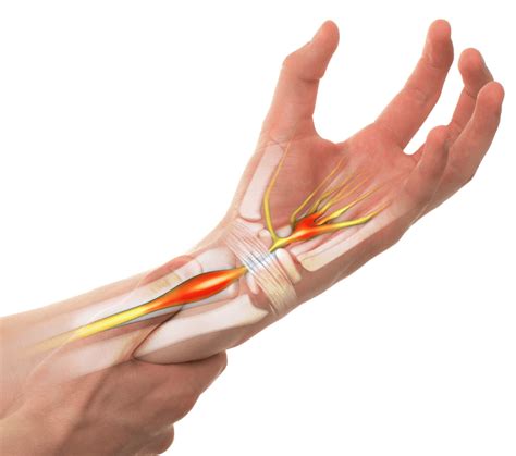 1 it is defined as the impairment of motor and/or sensory function of the median nerve as it traverses through the carpal tunnel. Carpal Tunnel Syndrome | Upswing Health