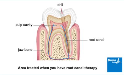 Your tooth will need to be opened by your dentist to remove you filling, and an attempt will be made. Root canal treatment | Health Information | Bupa UK
