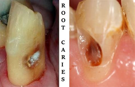 Root Caries Classification Causes Clinical Features And Treatment