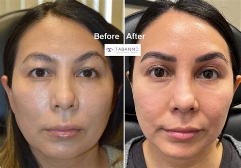 Eyelid And Facial Fat Injection Before And After Gallery Taban Md