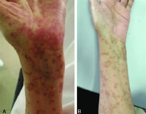 Rashes On The Patient With Angioimmunoblastic T Cell Lymphoma A